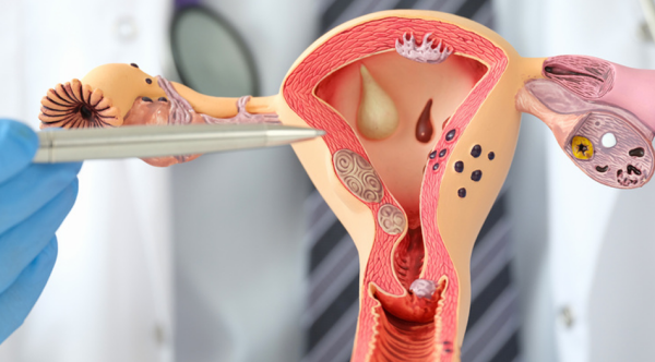 Baarmoederkanker-overleving-alle-vrouwen