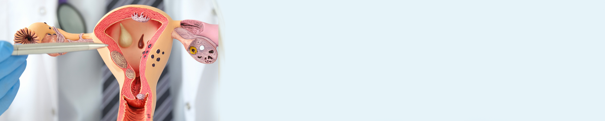 Baarmoederkanker-overleving-alle-vrouwen-header