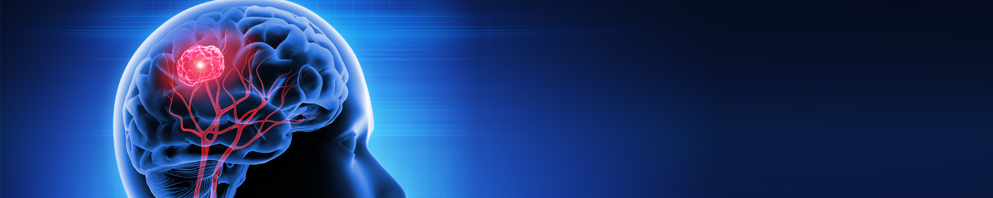 Hersentumoren algemeen header