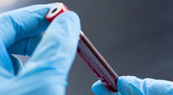 Leukemie-bloedsample